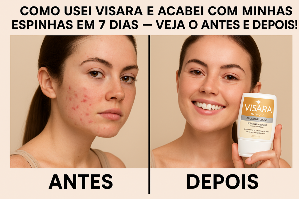 Como Usei Visara e Acabei com Minhas Espinhas em 7 Dias — Veja o Antes e Depois!