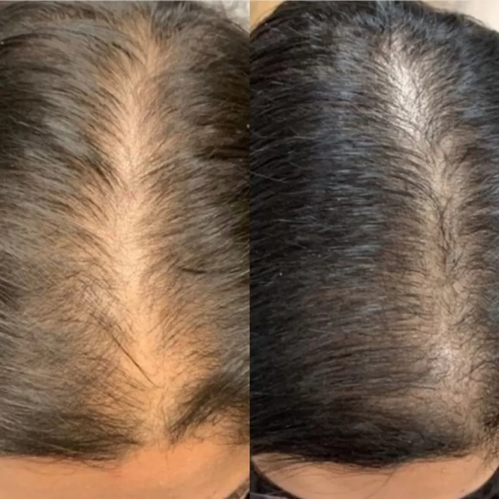 Minoxidil ou S.O.S Crescimento? Diferenças, Vantagens e Resultados